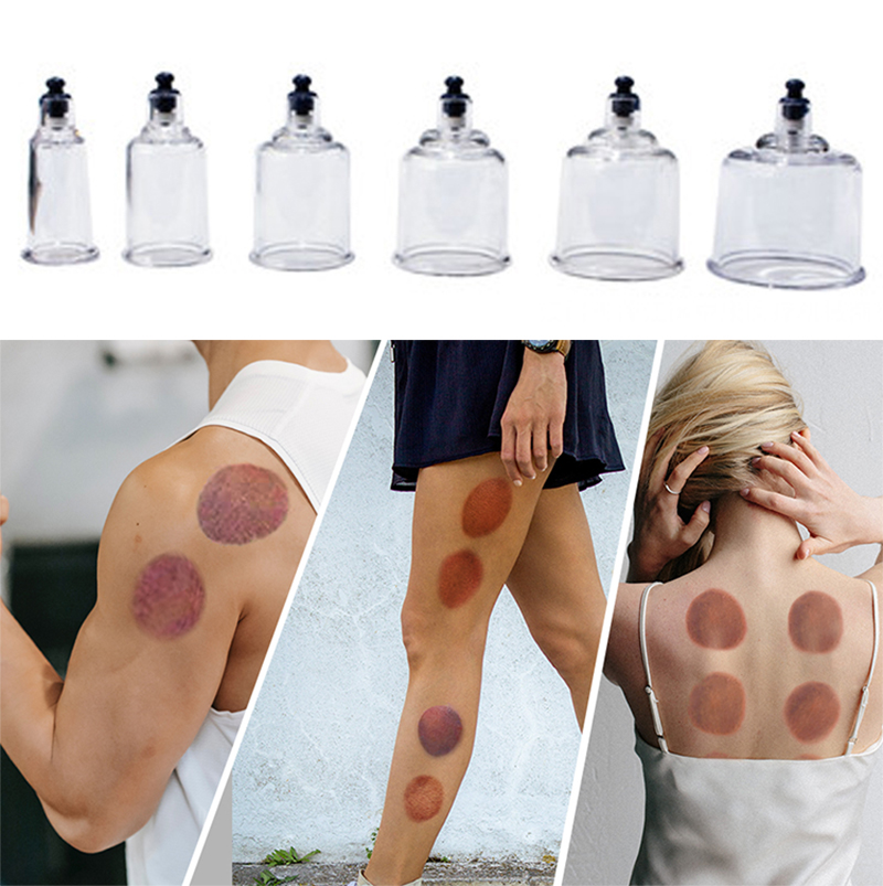 17 Blikjes Cupping Therapie Se - Cupping Therapy Set recensie en prijs